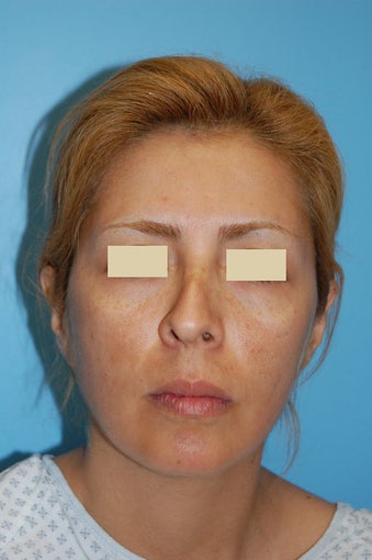 Revision Rhinoplasty before 166040