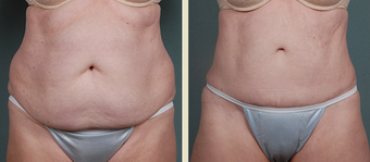 Tummy Tuck before 1377800