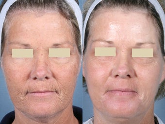 Laser Peel Treatments before 104658
