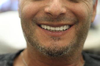 All-on-4 Dental Implants after 1138368