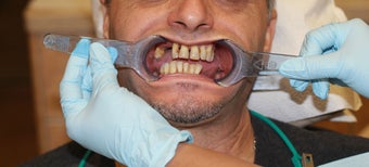 All-on-4 Dental Implants before 1138368