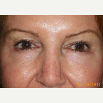 65-74 year old woman treated with Eyelid Surgery before 3493079