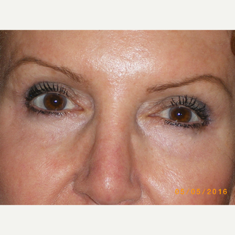 65-74 year old woman treated with Eyelid Surgery after 3493079