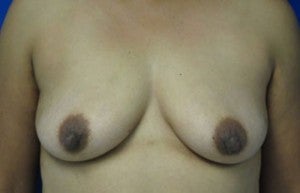Breast Augmentation before 3054775