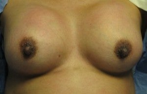 Breast Augmentation after 3054775