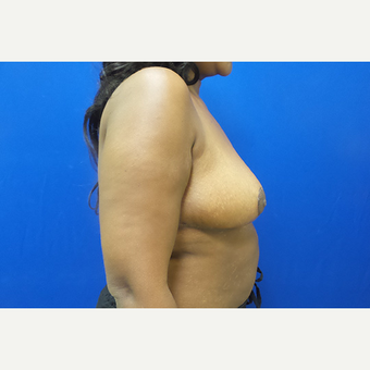 Breast Reduction and Lift after 3630787