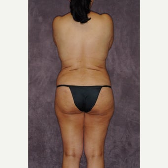55-64 year old woman treated with Brazilian Butt Lift before 2581904