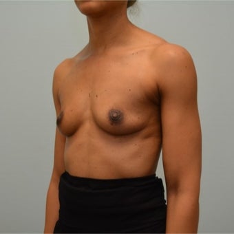 44 year old woman treated with Natrelle 410 styleFM (Full Height, Moderate Profile) implants. before 2198839