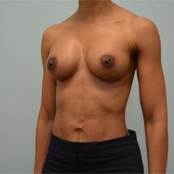 44 year old woman treated with Natrelle 410 styleFM (Full Height, Moderate Profile) implants. after 2198839