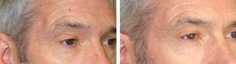 Injectable Treatments before 1200515