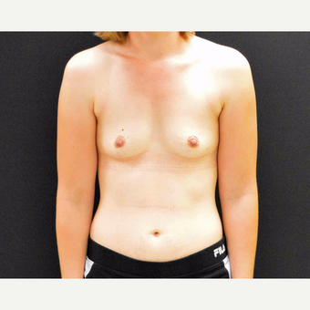 27 year old female who is 5'2" and 122 pounds underwent breast augmentation with 285cc silicone gel before 2990079