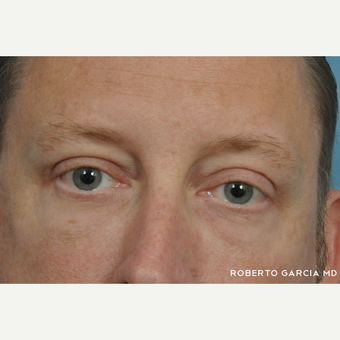 45-54 year old man treated with Eyelid Surgery after 3134719