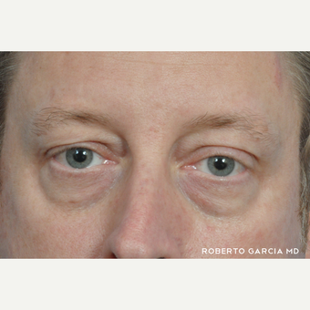 45-54 year old man treated with Eyelid Surgery before 3134719