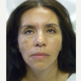 35-44 year old woman treated with Thread Lift before 3243268