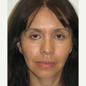 35-44 year old woman treated with Thread Lift after 3243268