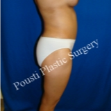 35-44 year old woman treated with Tummy Tuck after 3764924