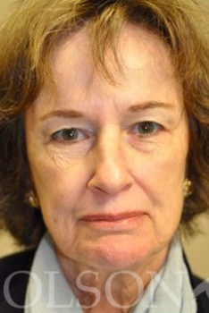 55-64 year old woman treated with Liquid Facelift before 2464390