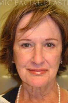55-64 year old woman treated with Liquid Facelift after 2464390