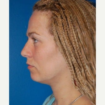 Fat Transfer before 1637871
