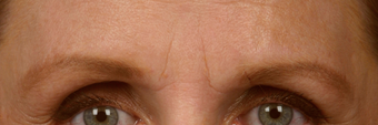 Botox before 301238