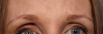 Botox after 301238