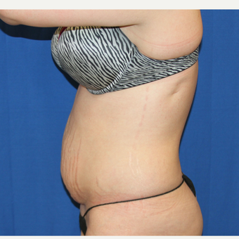 25-34 year old woman treated with Tummy Tuck before 3259036