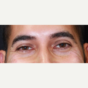 37 year old male treated with Botox for crow's feet before 3128893