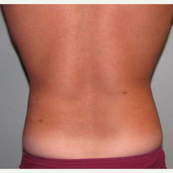 35-44 year old man treated with Liposuction after 3248829
