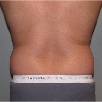35-44 year old man treated with Liposuction before 3248829
