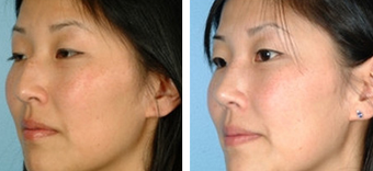 Asian Eyelid Surgery before 1208229