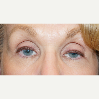 62 year old woman treated with bilateral ptosis surgery before 3148571