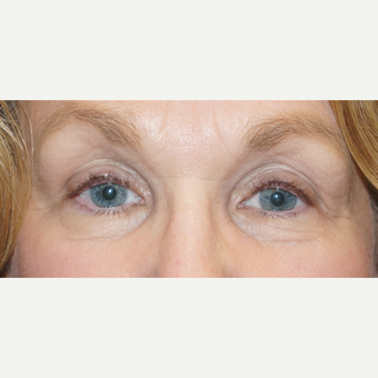 62 year old woman treated with bilateral ptosis surgery after 3148571