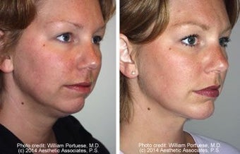 Liposuction of neck and chin with a chin implant before 6806