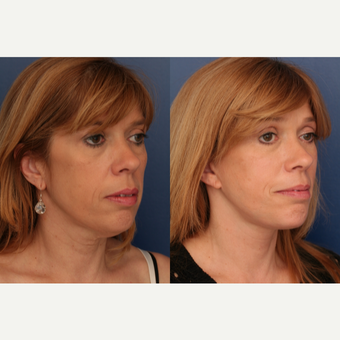 45-54 year old woman treated with Facelift after 3705843