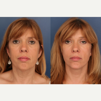 45-54 year old woman treated with Facelift before 3705843