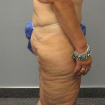 Body Lift before 3680292