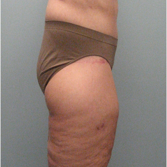 Body Lift after 3680292