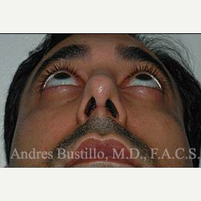 37 year old man treated with Rhinoplasty before 3462323