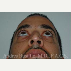 37 year old man treated with Rhinoplasty after 3462323