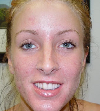 Acne patient treated with laser to clear her acne after 1328598