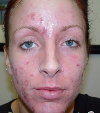 Acne patient treated with laser to clear her acne before 1328598