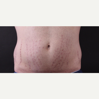 30 year old man treated with CoolSculpting before 3630331