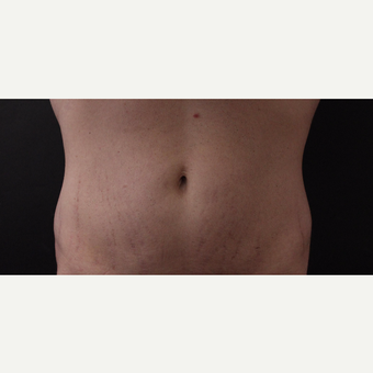 30 year old man treated with CoolSculpting after 3630331