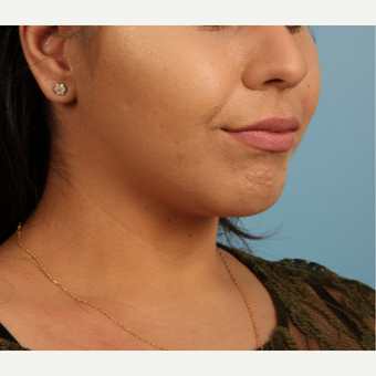 18-24 year old woman treated with Lip Augmentation before 3339297