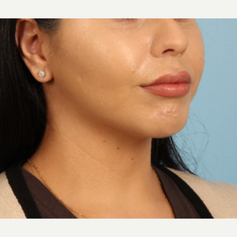 18-24 year old woman treated with Lip Augmentation after 3339297