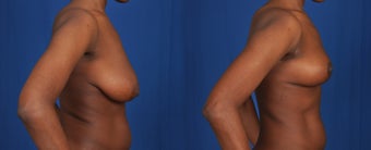 25-34 year old woman treated with Breast Reduction 3239899