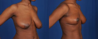 25-34 year old woman treated with Breast Reduction after 3239899