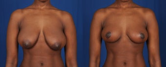 25-34 year old woman treated with Breast Reduction before 3239899