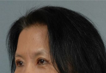 45-54 year old woman treated with Asian Eyelid Surgery after 3615935