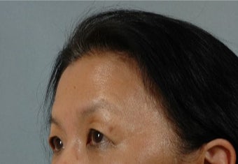 45-54 year old woman treated with Asian Eyelid Surgery before 3615935